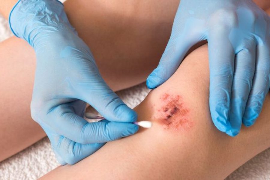 Cientistas desenvolvem espuma sintética capaz de curar feridas crônicas